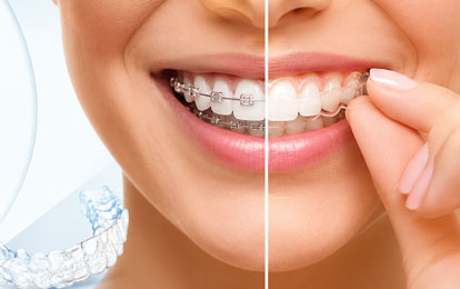 Braces & Aligners Treatment