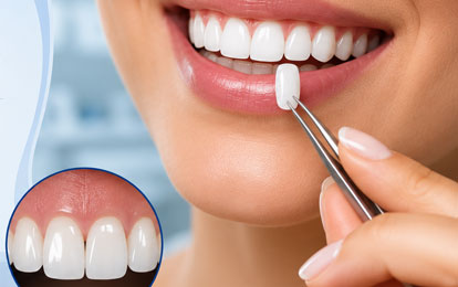 Ceramic Veneers