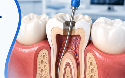 Root Canal Treatment