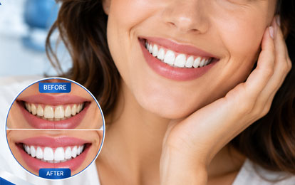 Smile Makeover Treatment